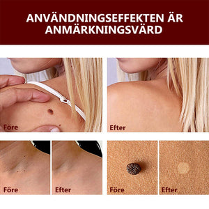 Borttagning av taggar och födelsemärken - Köp 1 och få 1 gratis (2 st)